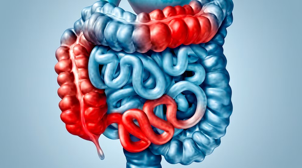 Avance científico: descubren cómo se origina la enfermedad inflamatoria&nbsp;intestinal